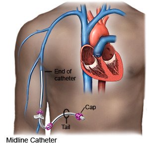 PICC Catheters