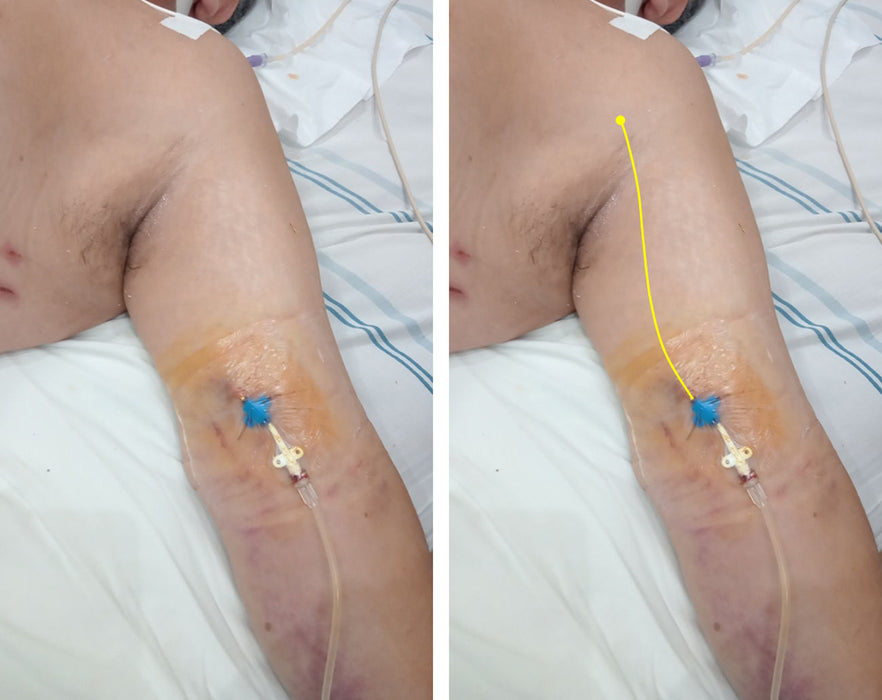 PICC Catheters